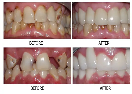 Before and after smile makeover result from a patient at Lakehurst Dental