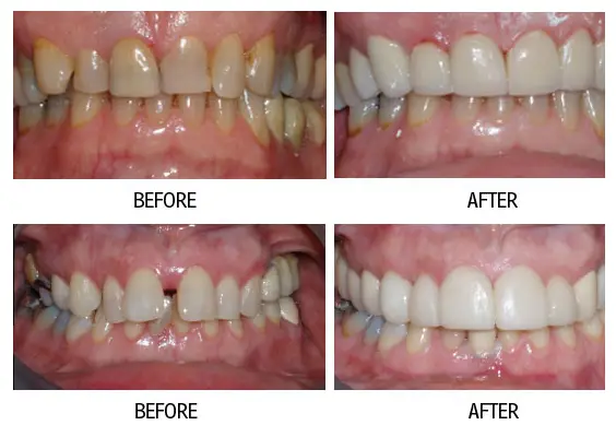 Before and after smile makeover result from a patient at Lakehurst Dental