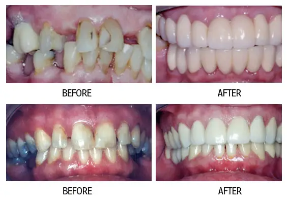 Before and after smile makeover result from a patient at Lakehurst Dental