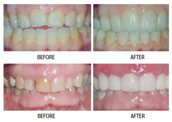 Before and after smile makeover result from a patient at Lakehurst Dental