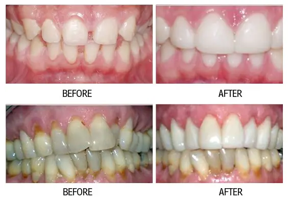 Before and after smile makeover result from a patient at Lakehurst Dental