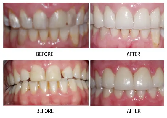 Before and after smile makeover result from a patient at Lakehurst Dental