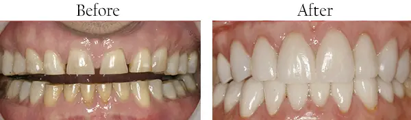 Before and after smile makeover result from a patient at Lakehurst Dental